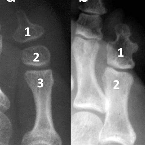 A A Normal Fifth Toe With Three Phalanges B Pedal Symphalangism