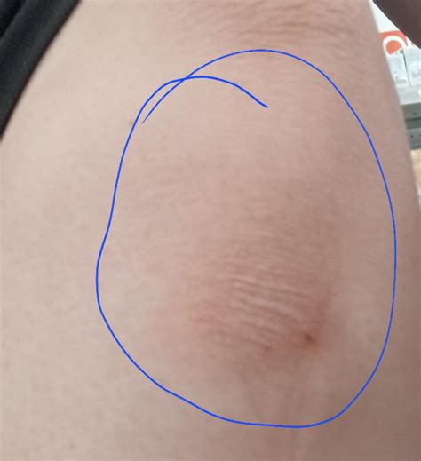 Right Below My F27 Knee Was Rock Hard Bump That Ive Had For The Past