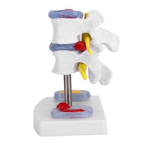 Lumbar Spine Model Lumbar Disc Herniation Demonstration Model For Human