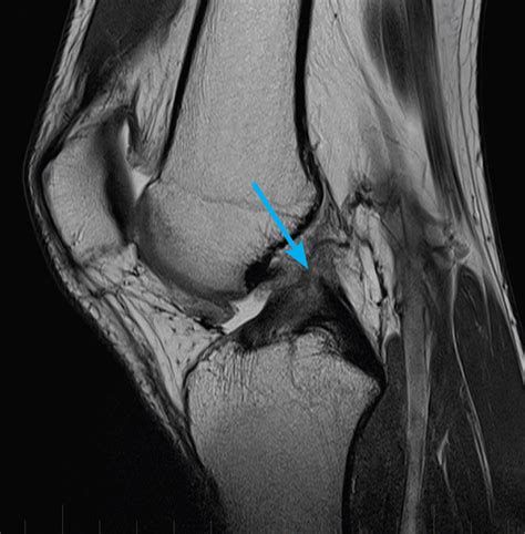 Mri Knee Acl Tear MRI At Melbourne Radiology Clinic
