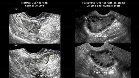 Polycystic Ovary Syndrome PCOS Cause Symptoms Treatment