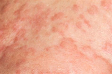 Graft Versus Host Disease The Dermatology Specialists