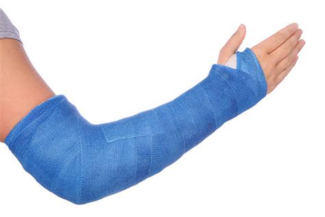 Broken Arm Stock Photos Pictures And Royalty Free Images Istock