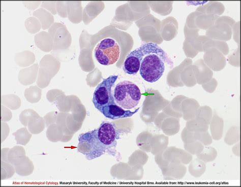 Plasma Cell Myeloma Cell Atlas Of Haematological Cytology