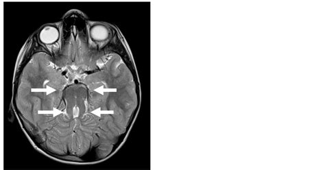 Ct And Mr Imaging Findings In The Joubert Syndrome A Ciliopathy