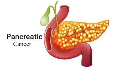 Pancreatic Cancer Types Stages Signs Symptoms Risk Factors Diagnostic Procedures Treatment