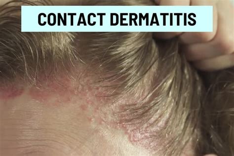 Red Spots On Scalp 11 Causes Pictures And Treatment