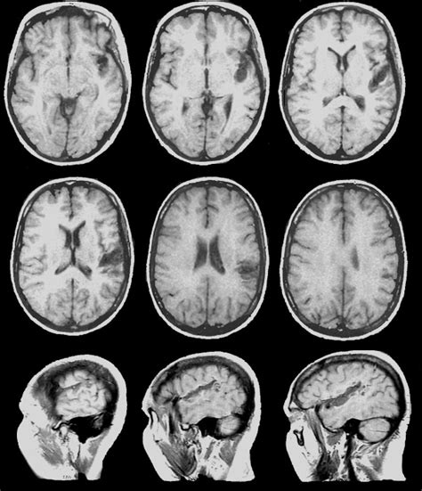 Magnetic Resonance Images Showing Encephalomalacia And Gliosis In The