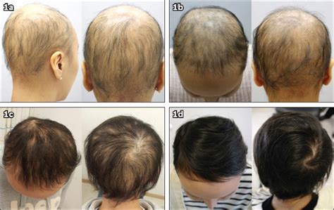 Successful Hair Regrowth In A Korean Patient With Alopecia Universalis