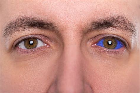 He explained the ink is injected into a. Eye Tattoos: The Trend That Could Harm Your Eyes - Eye ...