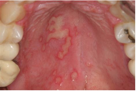 benign infectious lesions conditions of the oral mucous membrane intechopen