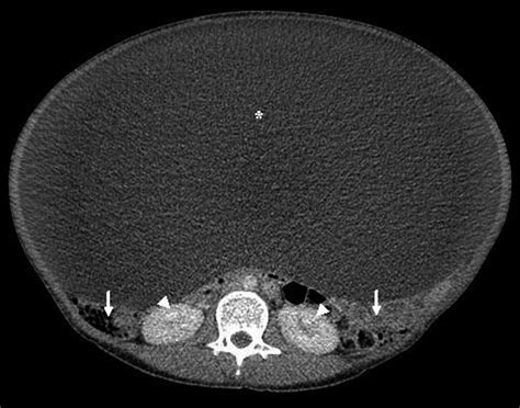 A Giant Ovarian Cyst Bmj Case Reports