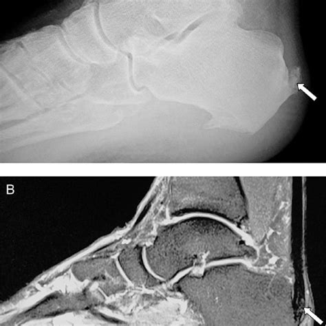 Retrocalcaneal Enthesiopathy Posterior To The Achilles Tendon Insertion
