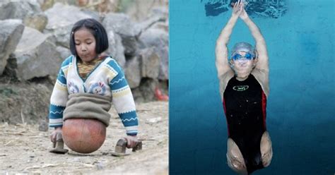 The Inspiring Story Of The Amputee Swimming Champion Who Did Not Lose Hope Despite Losing Her Legs