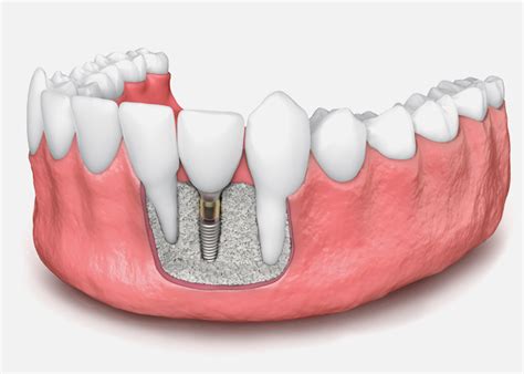 Bone Grafts To Support Your Dental Implants Your Dental Health Resource