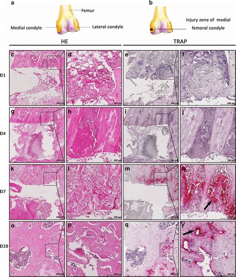 Osteoclasts Had A Stage Dependent Role In Bone Healing Rankl Signaling