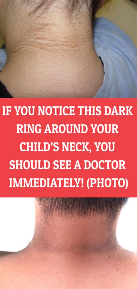 A Dark Circle Around Your Kids Neck Means You Should See A Doctor Asap