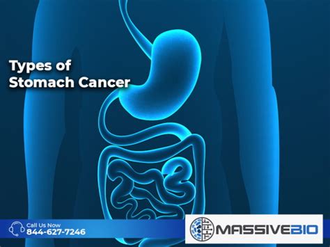 Types Of Stomach Cancer Massive Bio