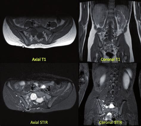 These Mri Scans Show A Year Old Female With Right Sacroiliac Joint My