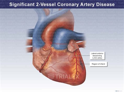 Significant 2 Vessel Coronary Artery Disease Trial Exhibits Inc
