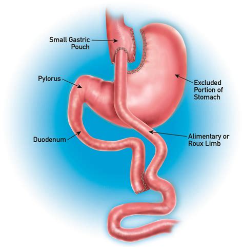 Gastric Bypass Surgery In Dallas And Plano Dr Malladi