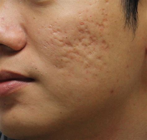 How To Remove Pimple Scars Acne Scar Treatment Singapore Niks Maple
