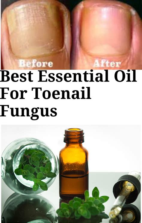 Best Essential Oil For Toenail Fungus Toenail Fungus Essential Oils