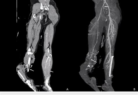 A Ct Of Lower Extremities Without Contrast Showing Bilateral Compound