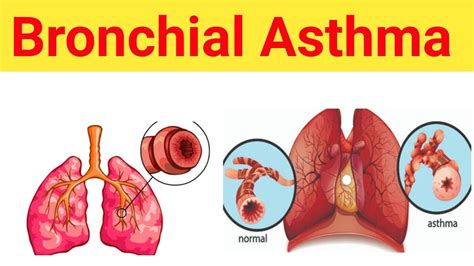 Bronchial Asthma Part 02 Pharmacology Classification Of Drugs Used