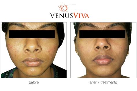 Venus Viva Procedure Beautiful Skin Treatment On Maui