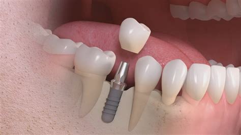 ¿qué Es Un Implante Dental Y Sus Fases Blog Clinica Dental Girbés