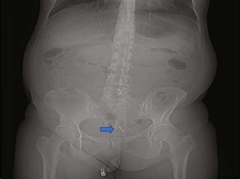 Womans Iud Eroded Through Her Uterus And Punctured Her Bladder
