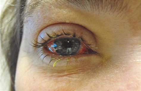 Epidemic Keratoconjunctivitis With Crusting Lid Edema And Conjunctival