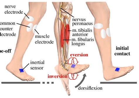 Drop Foot Treatment By Functional Electrical Stimulation Of The Nerve