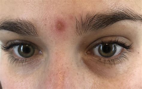 Pimples In Middle Of Eyebrows Eyebrowshaper