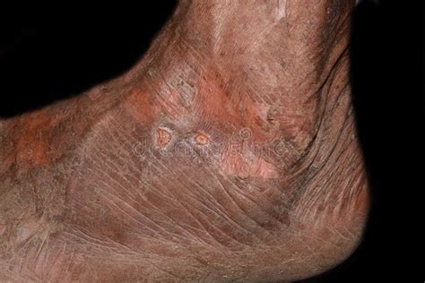 Dry And Scaly Skin And Abrasions In Foot Dermatitis Foot Stock Image