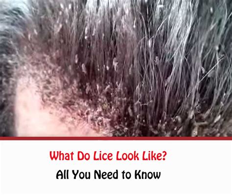 What Do Lice Look Like