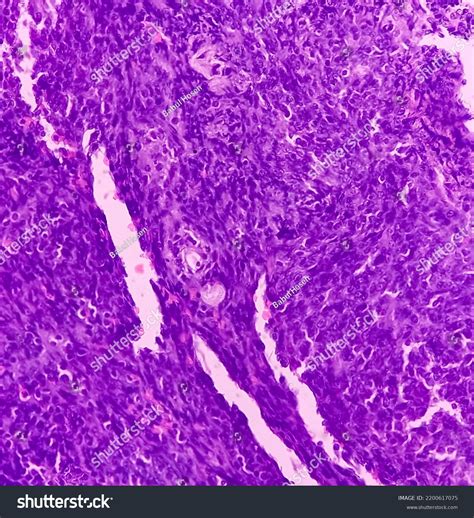 Supraclavicular Lymph Node Biopsy Microscopic Image Stock Photo