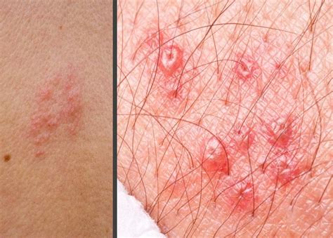 Pictures Of Skin Rashes Lovetoknow Health Wellness Skin Rash