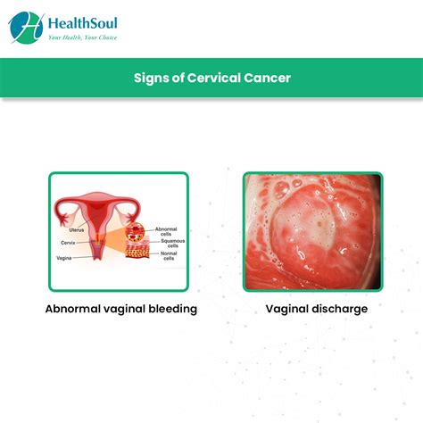 A doctor will usually do a vaginal examination if you have symptoms which may the treatment of cancer is a developing area of medicine. Cervical Cancer: Screening and Prevention | Gynecology ...