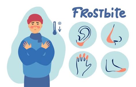 At What Temperature Can You Get Frostbite Signs And Symptoms To Look