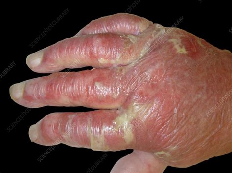 Infectious Cellulitis Stock Image C0548797 Science Photo Library