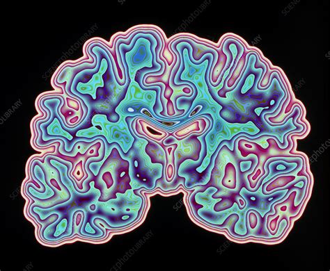 CT Scan Of Brain Stock Image P332 0336 Science Photo Library