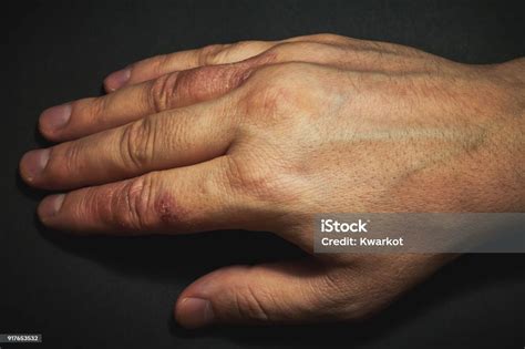 Hand Dermatitis Hand Eczema Stock Photo Download Image Now Allergy