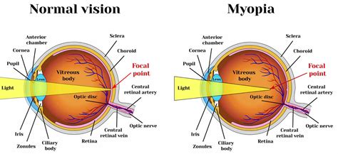 Myopia - Nearsighted Vision - Causes, Signs, Symptoms, Treatment