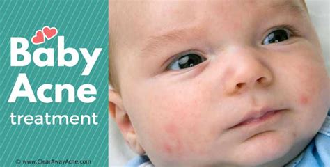 Baby Acne Treatment 5 Steps You Can Take Right Now Caa