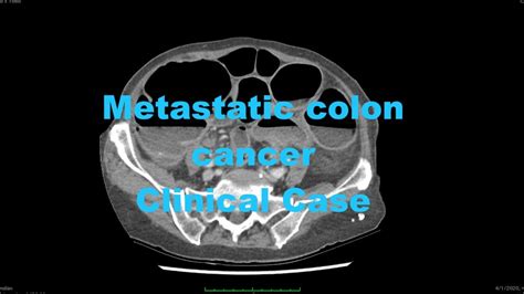 Clinical Case Metastatic Colon Cancer Ct Synchronous Sigmoid