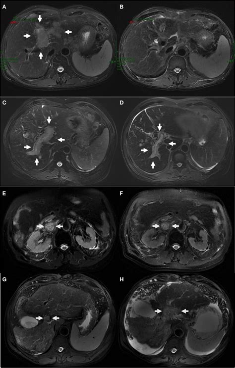 The Representative Mri Images Of Hcc With Complete Response Ab