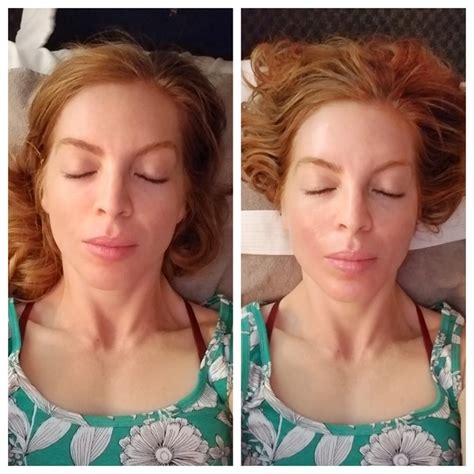 Massage Envy Chemical Peel Review And Before And After Pictures Run Eat Repeat