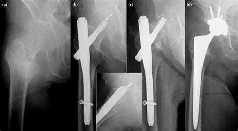 Figure 1 From Subcapital Femoral Neck Fracture After Fixation Of An